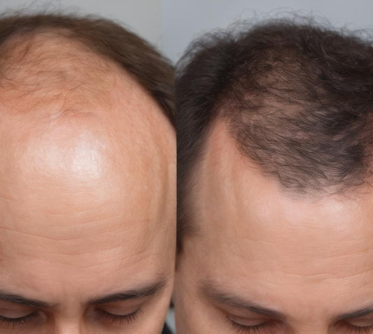 The Perfect Cut: Best Haircut Ideas for Receding Hairlines - Aomeisa